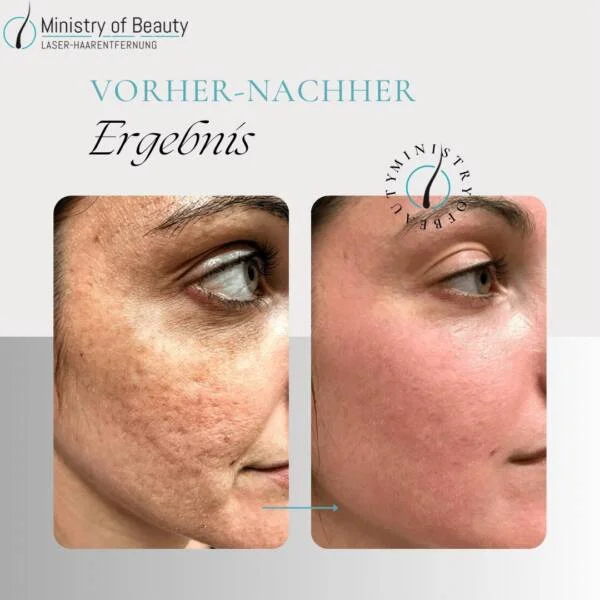 RF Microneedling, Radiofrequenz Microneedling, Hautstraffung Behandlung, Kollagen Induktion Therapie, Anti-Aging Hautbehandlung, Faltenreduktion Behandlung, Hautverjüngungsbehandlung, Nicht-chirurgisches Facelift